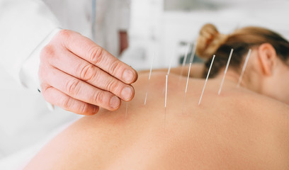 Acupuncturist inserting a needle into a female back. patient having traditional Chinese treatment using needles to restore an energy flow through specific points on the skin. - obrazy, fototapety, plakaty