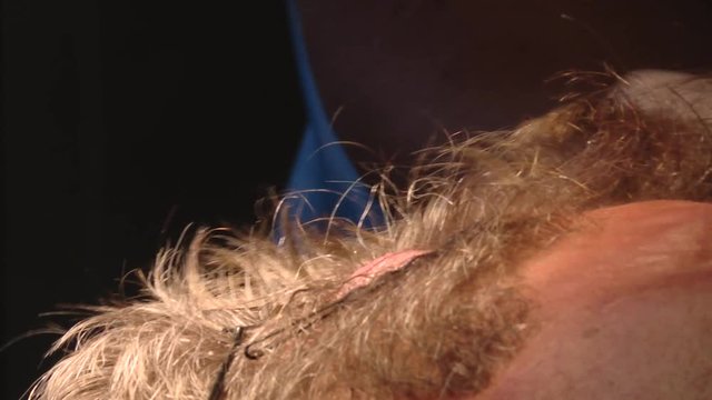 Surgical removal of scalp tumors. Removal of basal cell carcinoma. close up scalp hair got swell