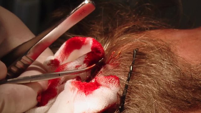 Surgical removal of scalp tumors. Removal of basal cell carcinoma.