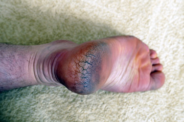 human heel crack, foot health problems, neglected heel of a human,