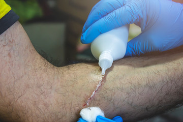 Doctor handles peroxide scratched hand, close-up