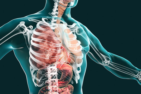 Pneumonia medical concept, 3D illustration showing lobar pneumonia of the right lung in the phase of grey hepatization