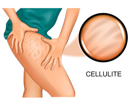cellulite on a woman's thigh