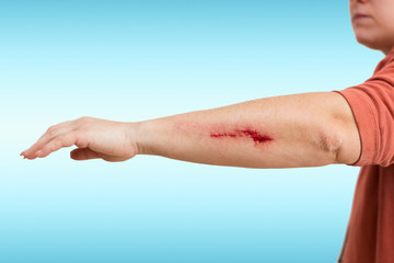 abrasion on a womans arm