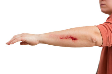 abrasion on a womans arm
