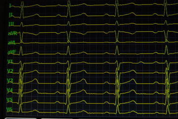 Screen of electrocardiograph device showing twelve yellow ECG cardiography heart rythm leads.