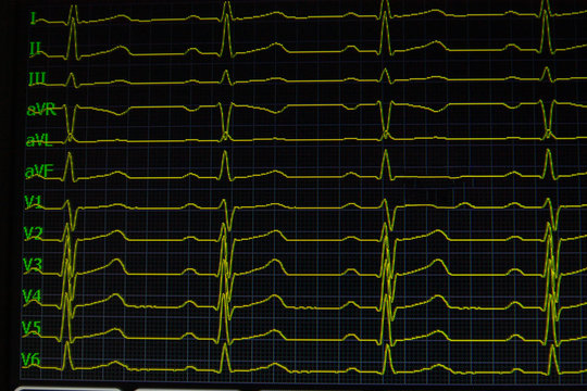 Screen of electrocardiograph device showing twelve yellow ECG cardiography heart rythm leads.