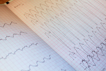 Close up view of an electrocardiogram paper.