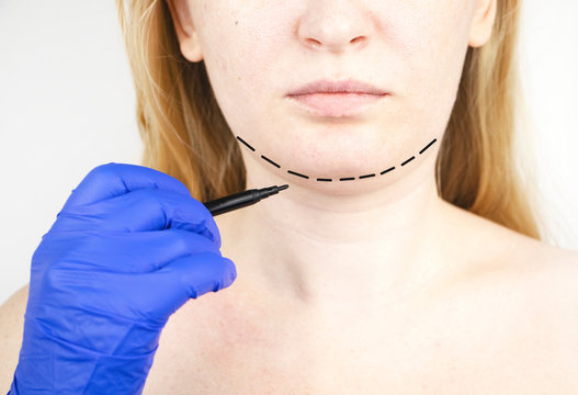 Mentoplasty: plastic chin. Patient before chin and neck surgery. Plastic surgeon advises