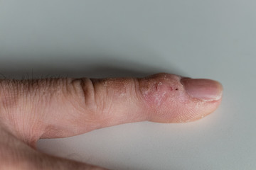 Side shot of an ugly pinky finger with fissures on a white background. The finger was compulsively bitten due to nervousness