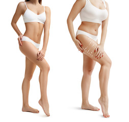 Two young thick and thin women have different figures. Comparison concept. Slim and fat girls. Fat lose, liposuction and cellulite removal concept. Marks on the woman before plastic surgery. Image is - obrazy, fototapety, plakaty