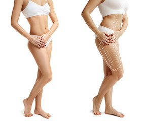 Two young thick and thin women have different figures. Comparison concept. Slim and fat girls. Fat lose, liposuction and cellulite removal concept. Marks on the woman before plastic surgery. Image is