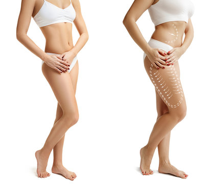 Two Young Thick And Thin Women Have Different Figures. Comparison Concept. Slim And Fat Girls. Fat Lose, Liposuction And Cellulite Removal Concept. Marks On The Woman Before Plastic Surgery. Image Is