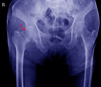 X-ray image of painful hip in woman present fracture right hip joint
