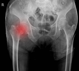 x-ray both hip fracture neck femoral.