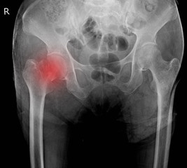 x-ray both hip fracture neck femoral.