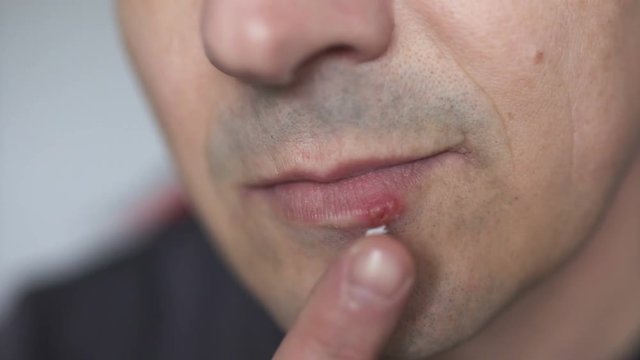 Man applying ointment on cold sore