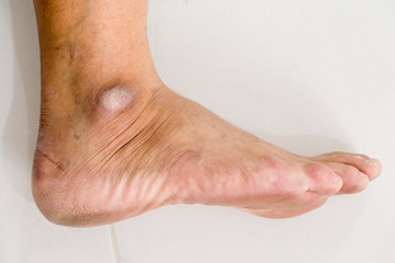 Closed-up of a dry and cracked heel, crack heel on white background