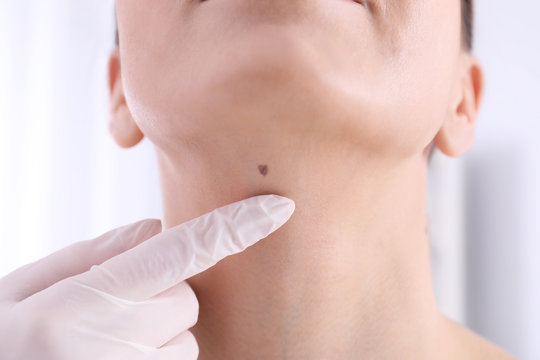 Dermatologist examining patient in clinic, closeup view