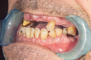 Obraz premium rotten teeth, caries and plaque close-up in an asocially ill patient. The concept of poor hygiene and health problems