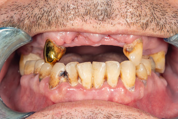 Dental caries. Filling with dental composite photopolymer material using rabbders. The concept of...