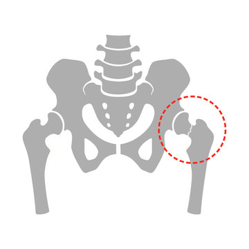 Femoral neck fracture. Fragment of the structure of the human skeleton. Pelvic girdle and thighs. Silhouette. Sign.