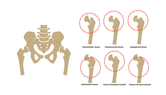 6 Types of Femoral Neck Fracture. Fragment of the structure of the human skeleton. Pelvic girdle and thighs. Silhouette. Sign.