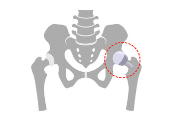 Hip replacement partly half. Illustration. Isolated on white background