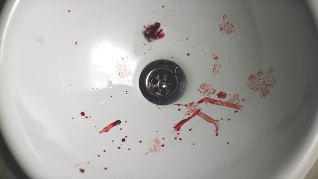 Close-up of sink with blood drops. Small drops of blood from nose and fleece in white shell. Human health affected