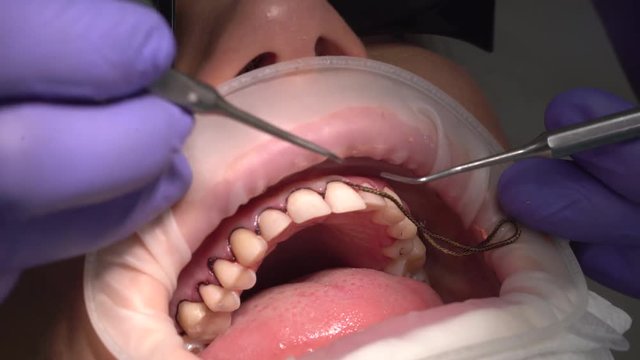 Clinic dentistry, installation of veneers to patient in dental clinic. Dentist doctor beautiful teeth, smile, Close up Minimally invasive porcelain veneers, Dental technician medicine cosmetic dentist