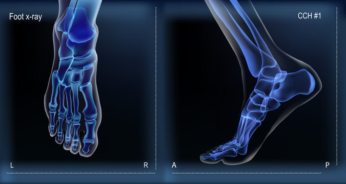 Medial and top view x ray of bones the of foot.