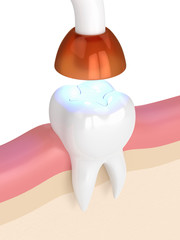 3d render of tooth with dental polymerization lamp and light cured inlay