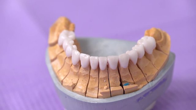 Clinic dentistry, installation of veneers to patient in dental clinic. Dentist doctor beautiful teeth, smile, Close up Minimally invasive porcelain veneers, Dental technician medicine cosmetic dentist