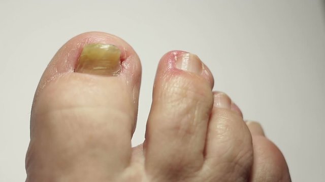 Toes of the right foot of a person with a fungal infection on the big toe