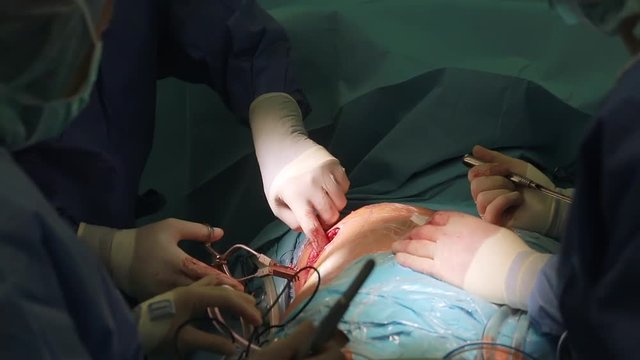 Team of surgeons operating wearing lamp lighting electric cautery and flex clamp, heart surgery intervention close-up replace valve open cord surgery minimally invasive surgeon. Live Heart Beating