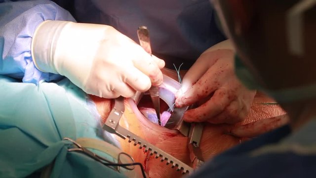 Surgeon doctor operating wearing lamp lighting electric cautery and flex clamp, heart surgery intervention close-up replace valve open cord surgery minimally invasive surgery. Live Heart Beating