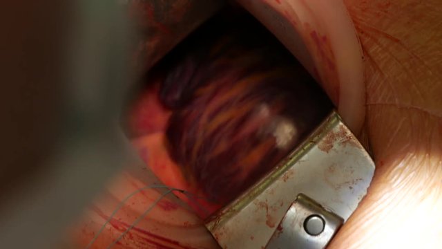 Closeup cardiovascular open heart surgery instruments in surgeon operation electrosurgery doctor in surgery center for interventions with thoracotomy microsurgery minimal invasive