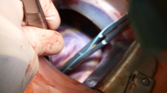 Close up cardiovascular surgery doctor in surgery center for interventions with instruments in surgeon operation electrosurgery with thoracotomy microsurgery minimal invasive open heart surgery