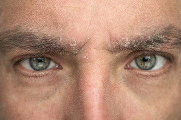 psoriasis on the eyebrow close up, dermatological diseases, skin problems