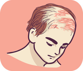 Man Symptom Scalp Blistering Illustration