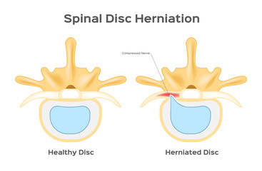Spinal disc herniation / human back infographic vector