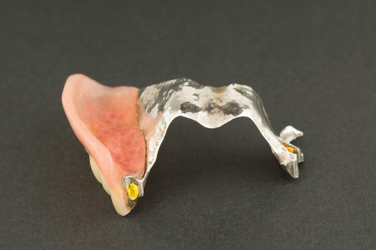large image of a modern arc denture with attachmens