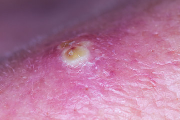 Purulent pimple on human skin