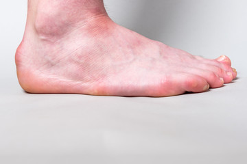 Bump on the back of heel bone called Haglund's deformity on gray background. - obrazy, fototapety, plakaty