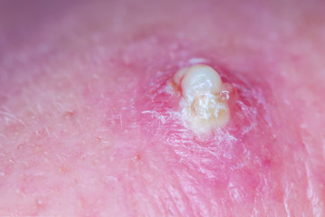 Purulent pimple on human skin