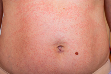 Fototapeta premium Skin rash. Allergic reaction. Red spots on the body.