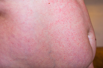 Skin rash. Allergic reaction. Red spots on the body.