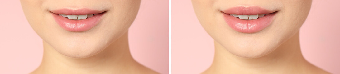 Woman before and after lips augmentation procedure on color background, closeup