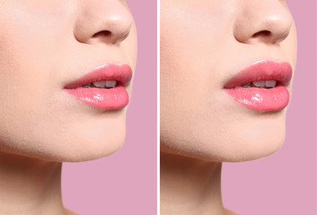 Woman before and after lips augmentation procedure on color background, closeup