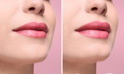 Woman before and after lips augmentation procedure on color background, closeup